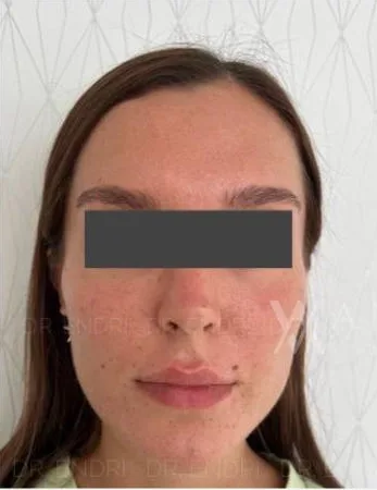 Before Dermal Filler treatment at Anaya Aesthetics Bali