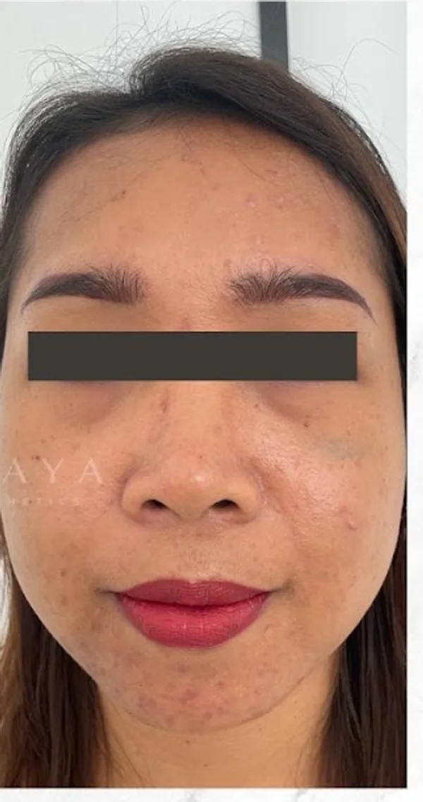 After Acne Skin Booster treatment at Anaya Aesthetics Bali