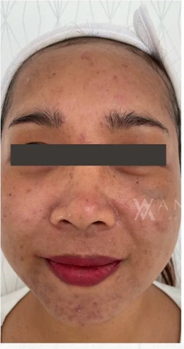 Before Acne Skin Booster treatment at Anaya Aesthetics Bali