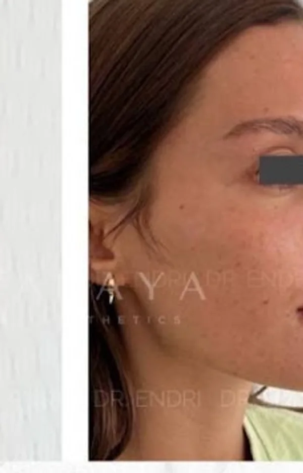 After Cheek & Chin Filler treatment at Anaya Aesthetics Bali