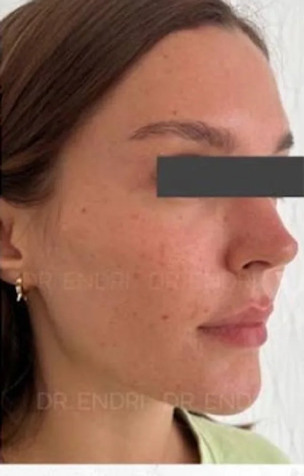 Before Cheek & Chin Filler treatment at Anaya Aesthetics Bali