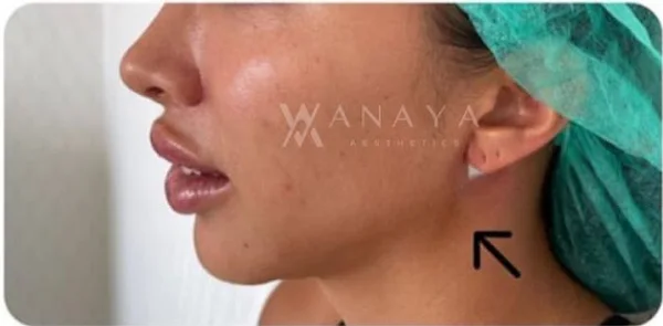 After Jawline Threadlift treatment at Anaya Aesthetics Bali
