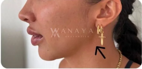 Before Jawline Threadlift treatment at Anaya Aesthetics Bali