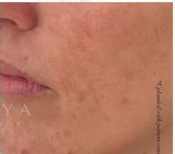 After Melasma Treatment treatment at Anaya Aesthetics Bali