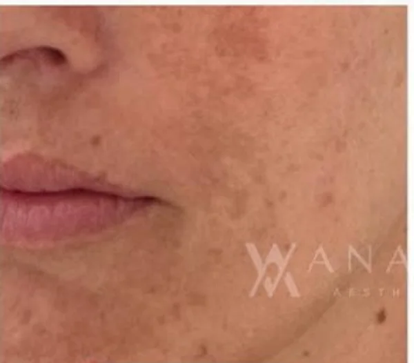 Before Melasma Treatment treatment at Anaya Aesthetics Bali