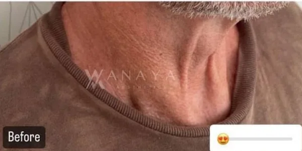 Before Profhilo Neck treatment at Anaya Aesthetics Bali