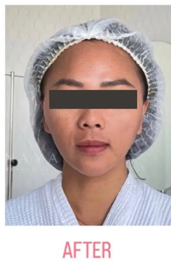 After Threadlift treatment at Anaya Aesthetics Bali