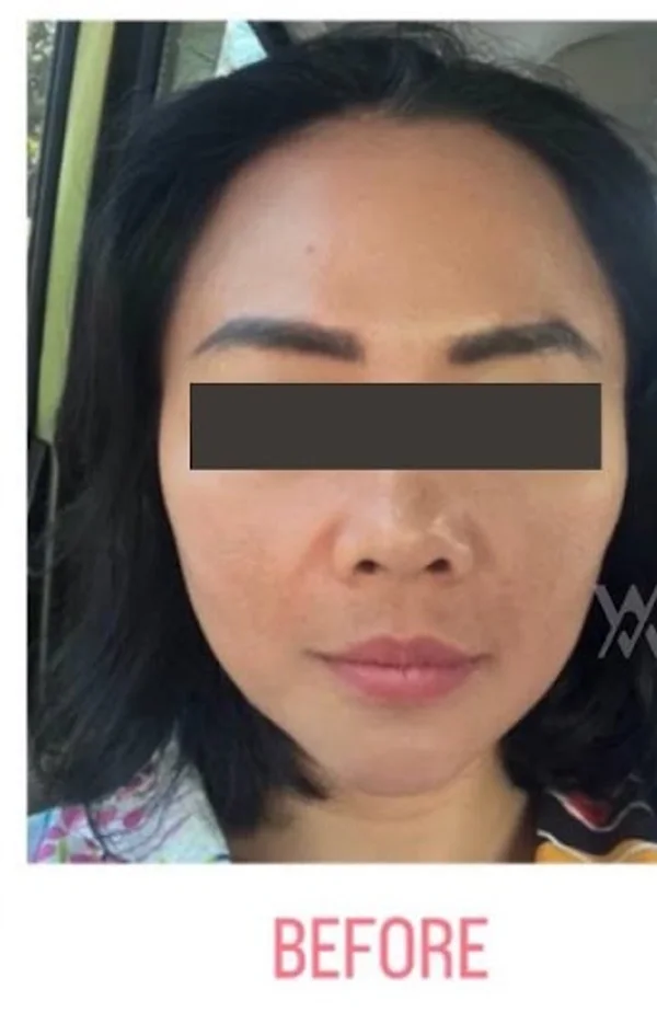 Before Threadlift treatment at Anaya Aesthetics Bali