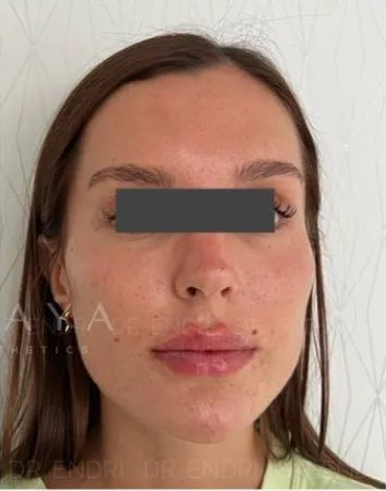 After Dermal Filler treatment at Anaya Aesthetics Bali