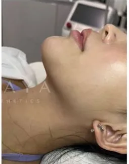 After HIFU treatment at Anaya Aesthetics Bali