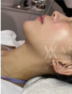 Before HIFU treatment at Anaya Aesthetics Bali