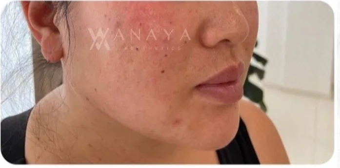 After Jawline Filler treatment at Anaya Aesthetics Bali