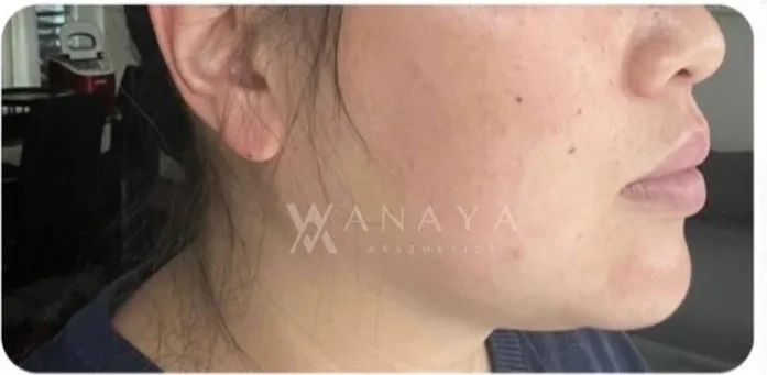 Before Jawline Filler treatment at Anaya Aesthetics Bali