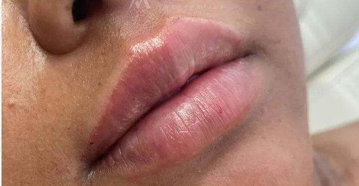 After Lip Filler treatment at Anaya Aesthetics Bali