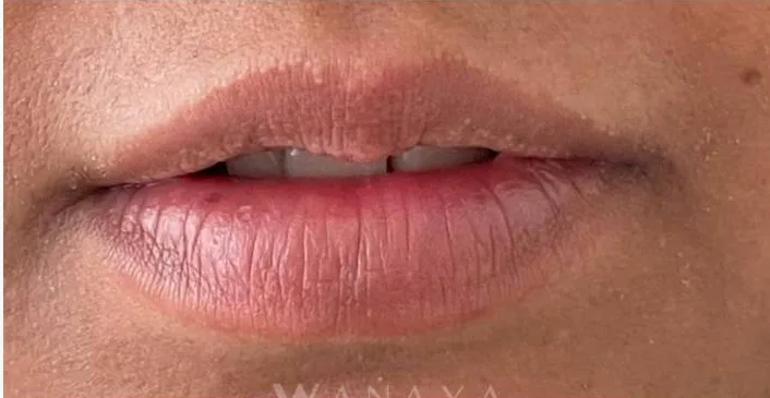 Before Lip Filler treatment at Anaya Aesthetics Bali