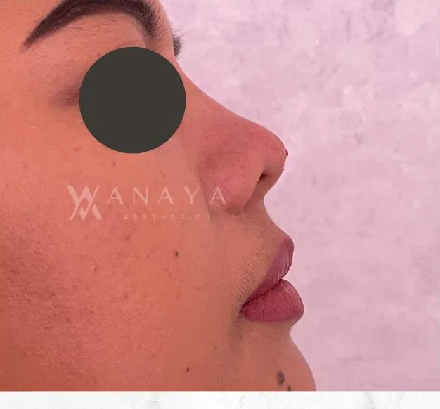 After Nose Threadlift treatment at Anaya Aesthetics Bali