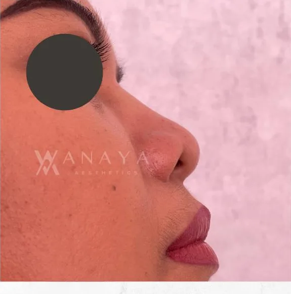 Before Nose Threadlift treatment at Anaya Aesthetics Bali