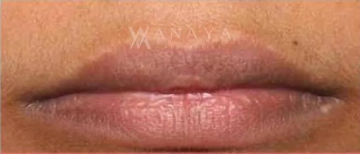 After Pico Laser treatment at Anaya Aesthetics Bali
