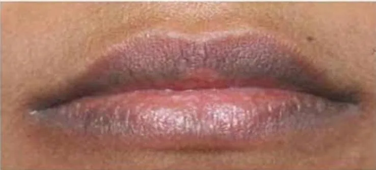 Before Pico Laser treatment at Anaya Aesthetics Bali
