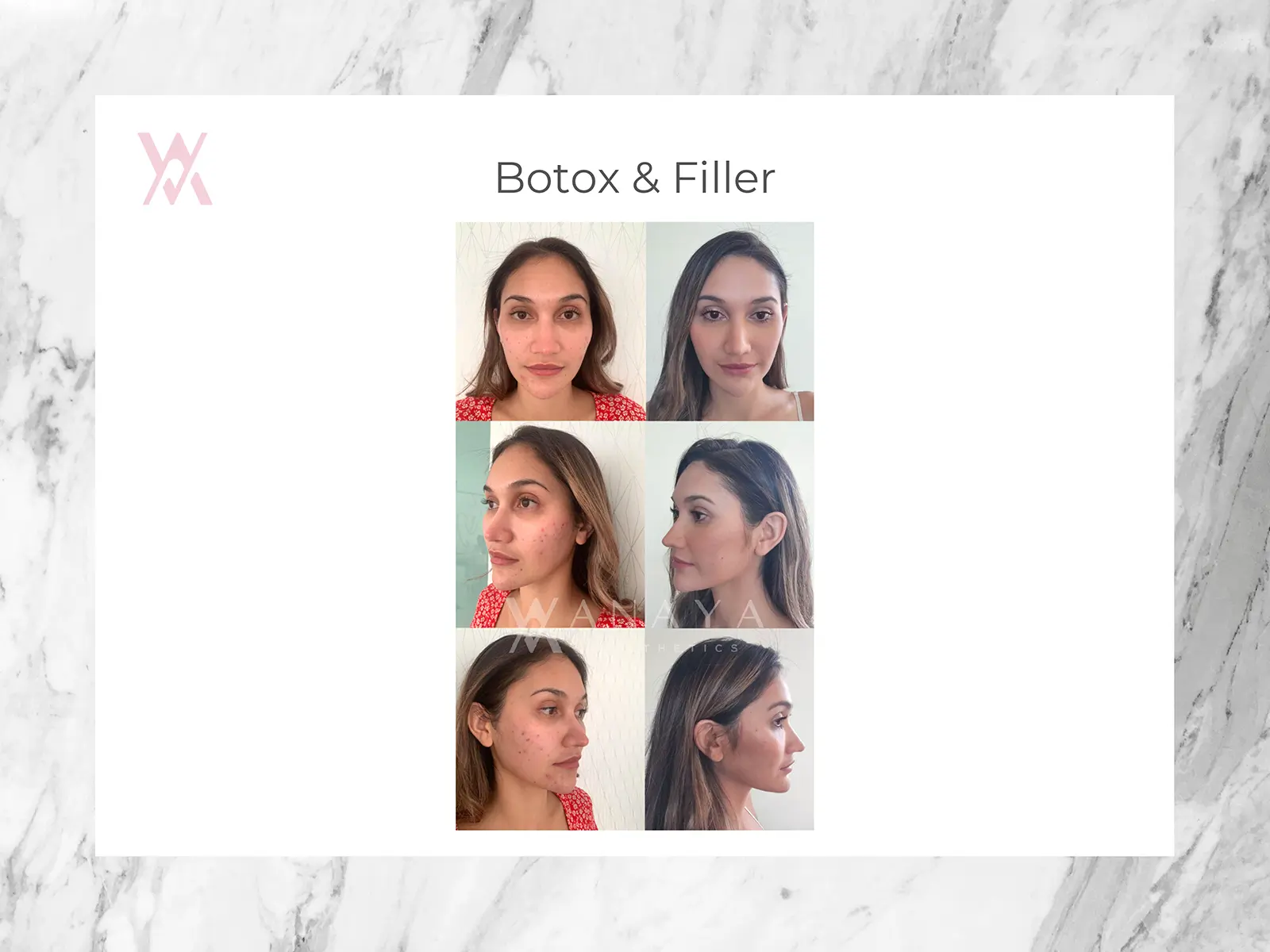 Botox & Filler