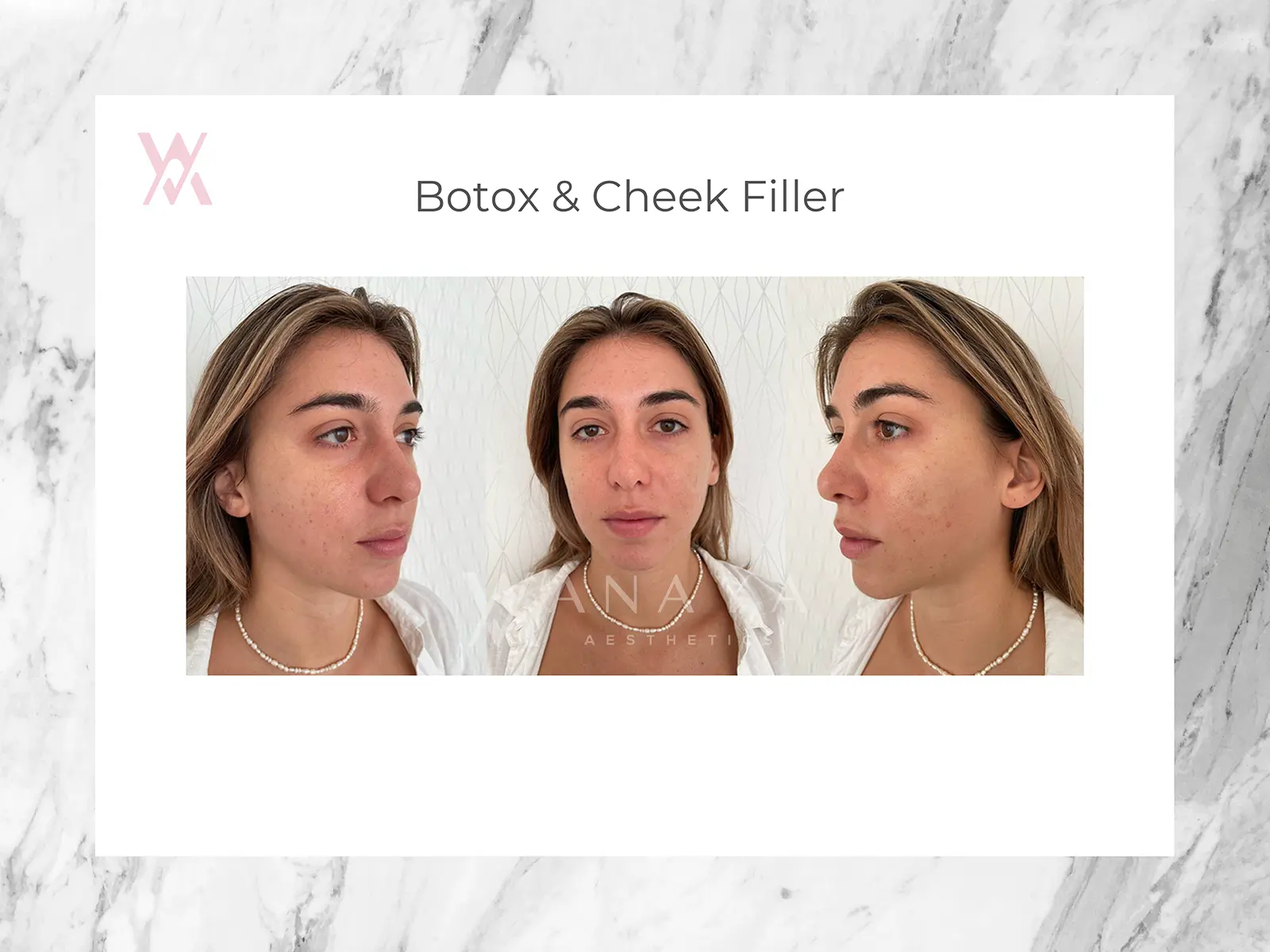 Botox & Cheek Filler