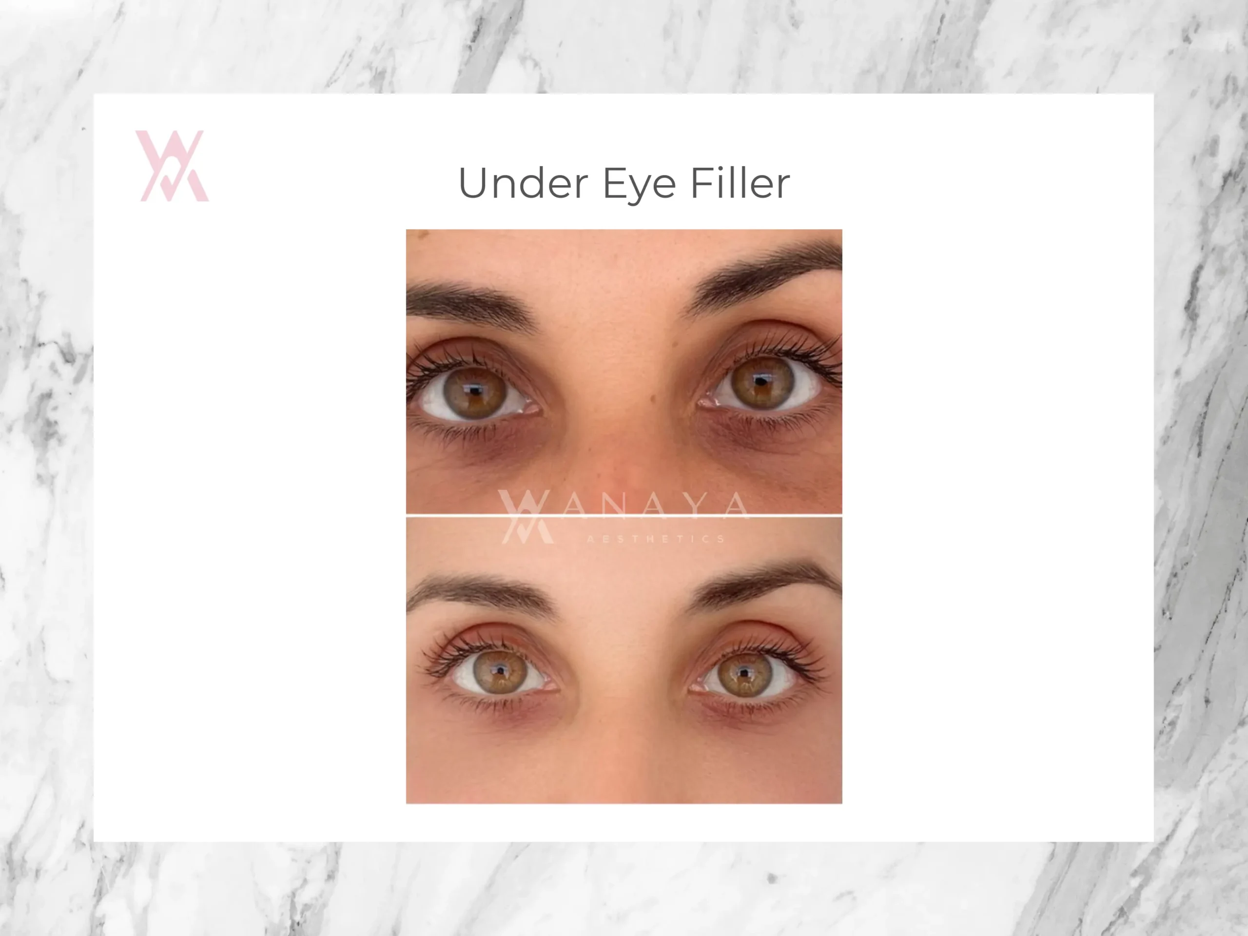 Under Eye Filler