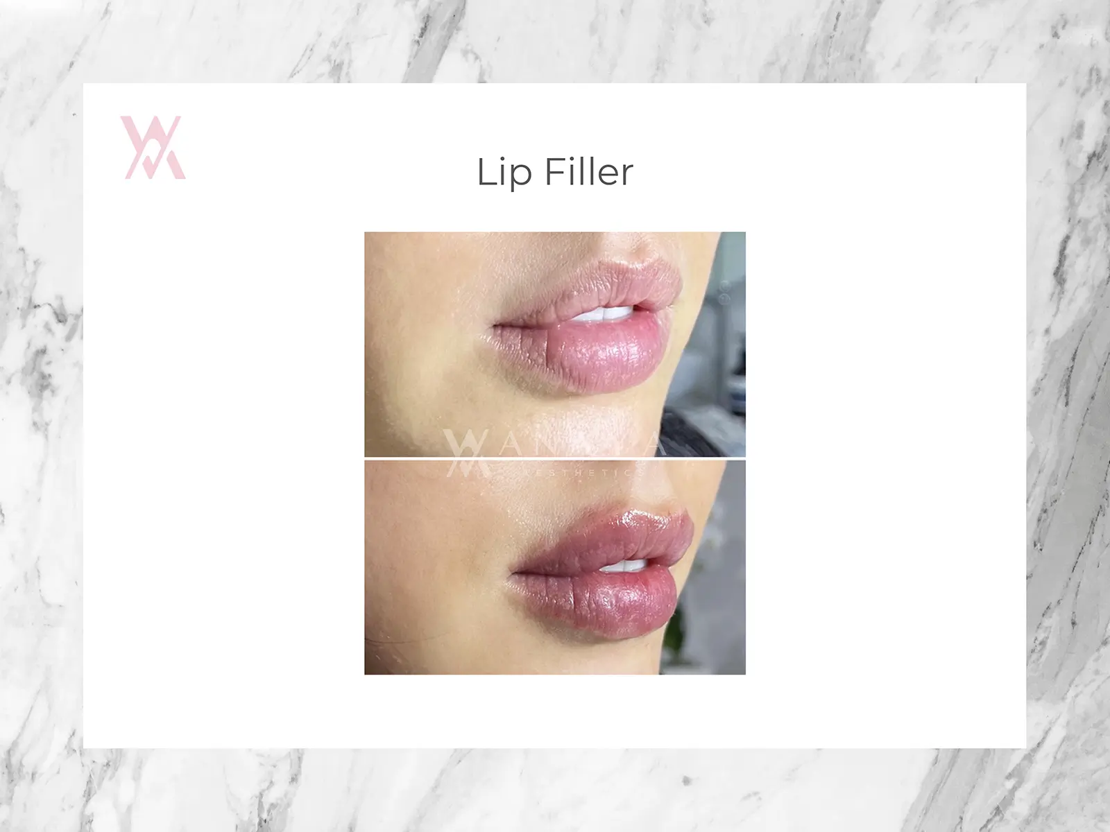 Lip Filler