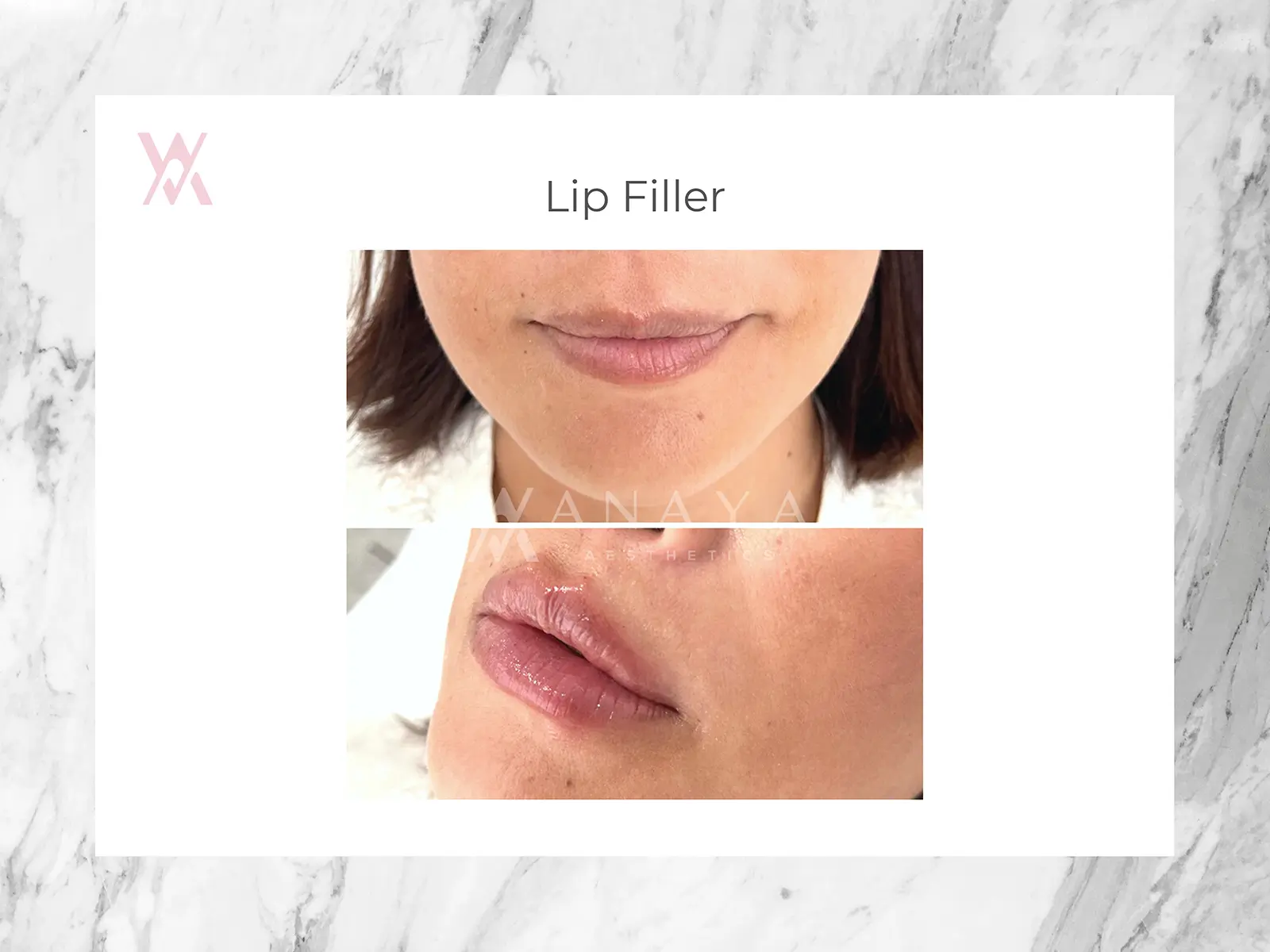 Lip Filler