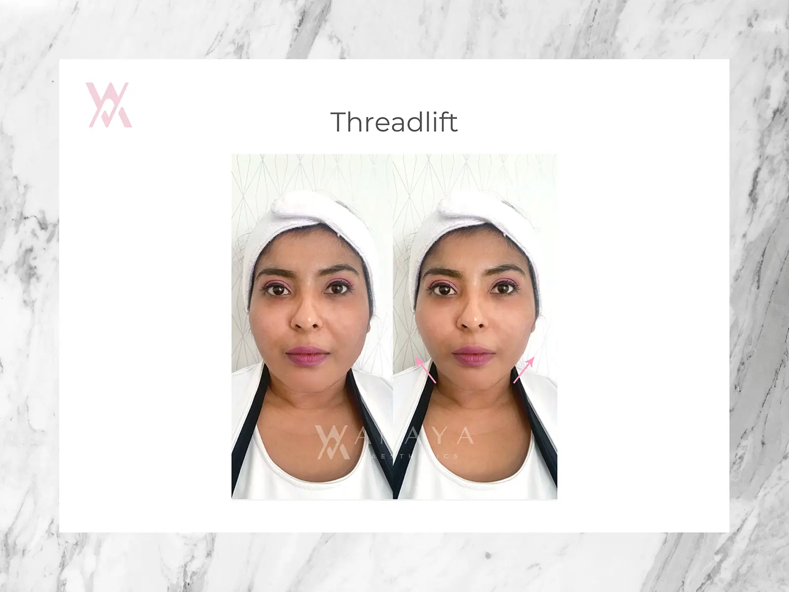 Threadlift