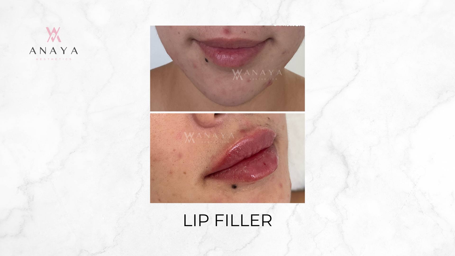 Lip Filler