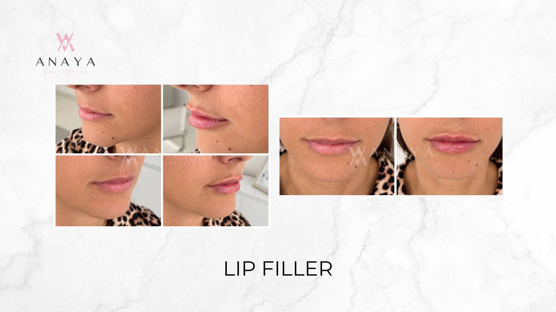 Lip Filler