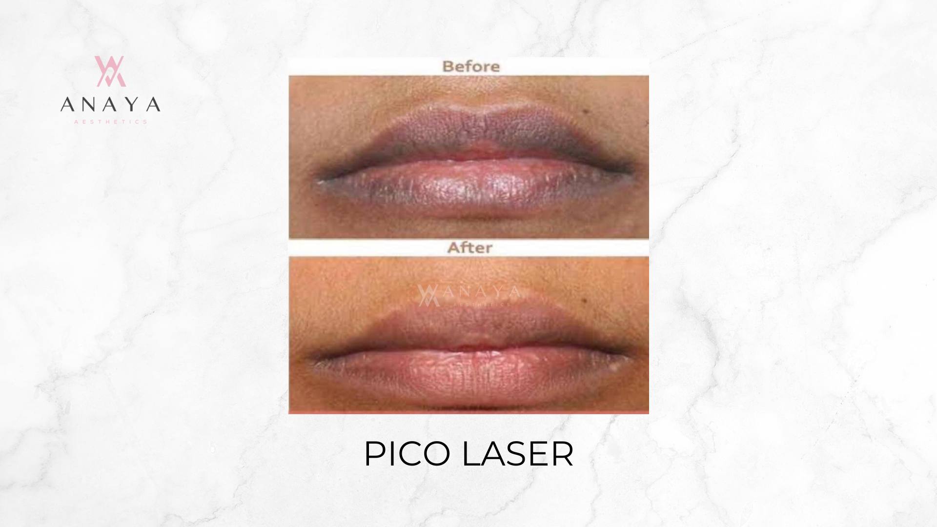 Pico Laser