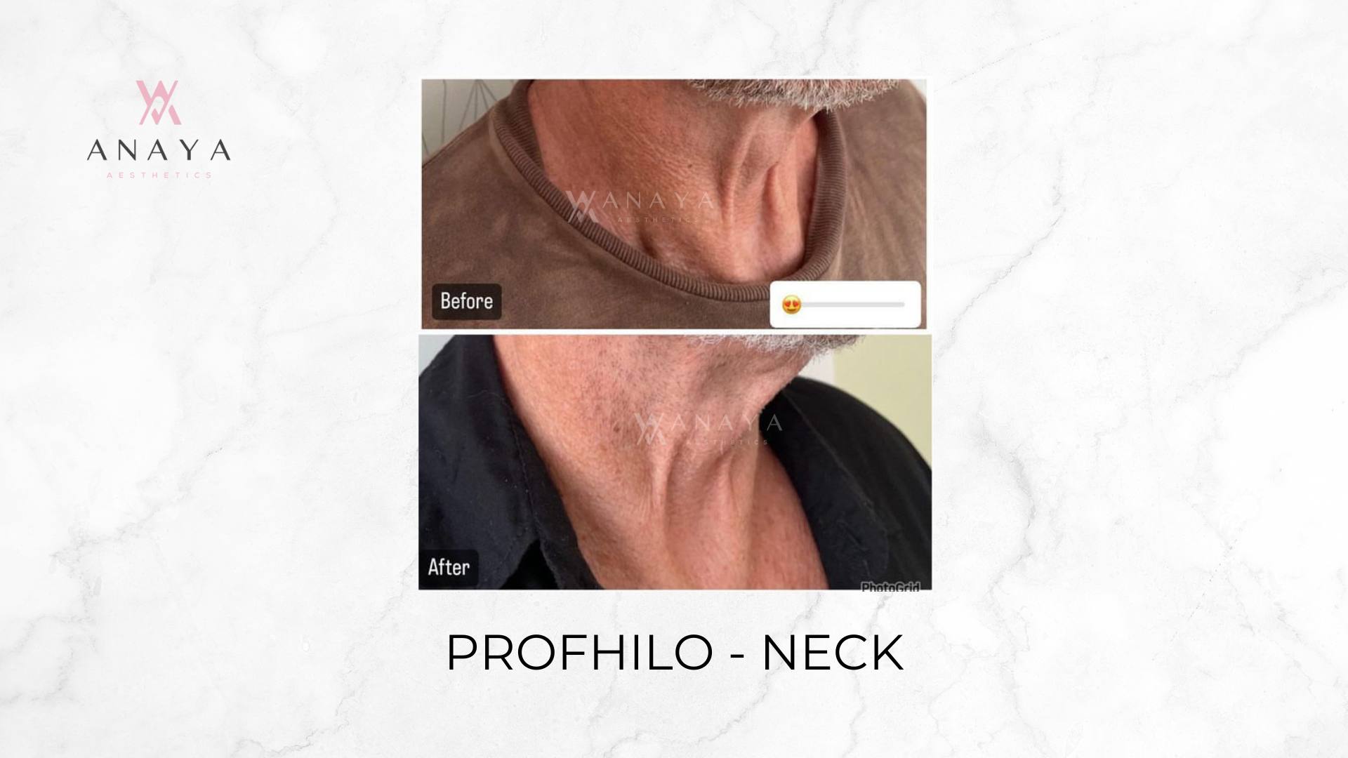 Profhilo - Neck