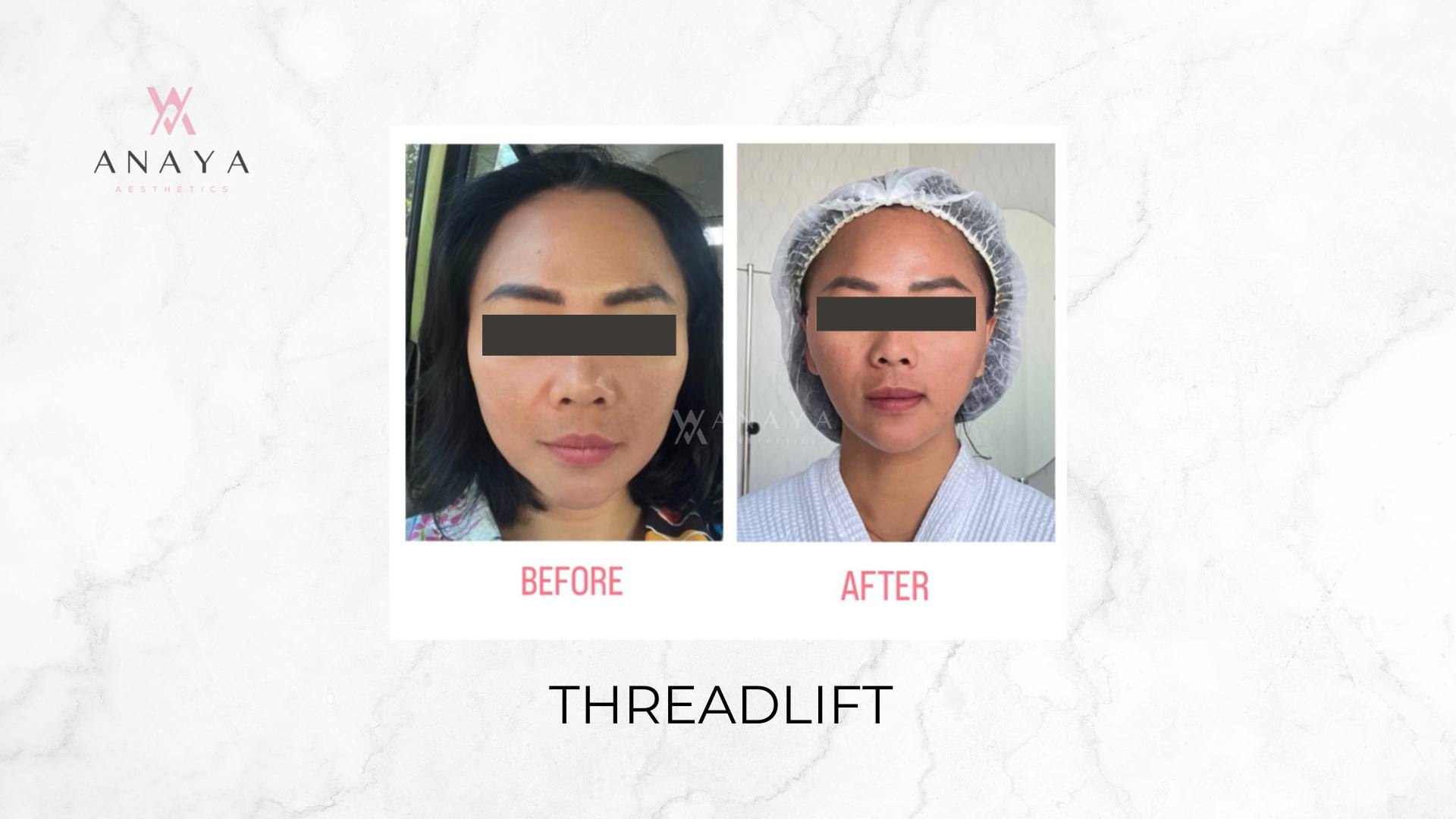 Threadlift