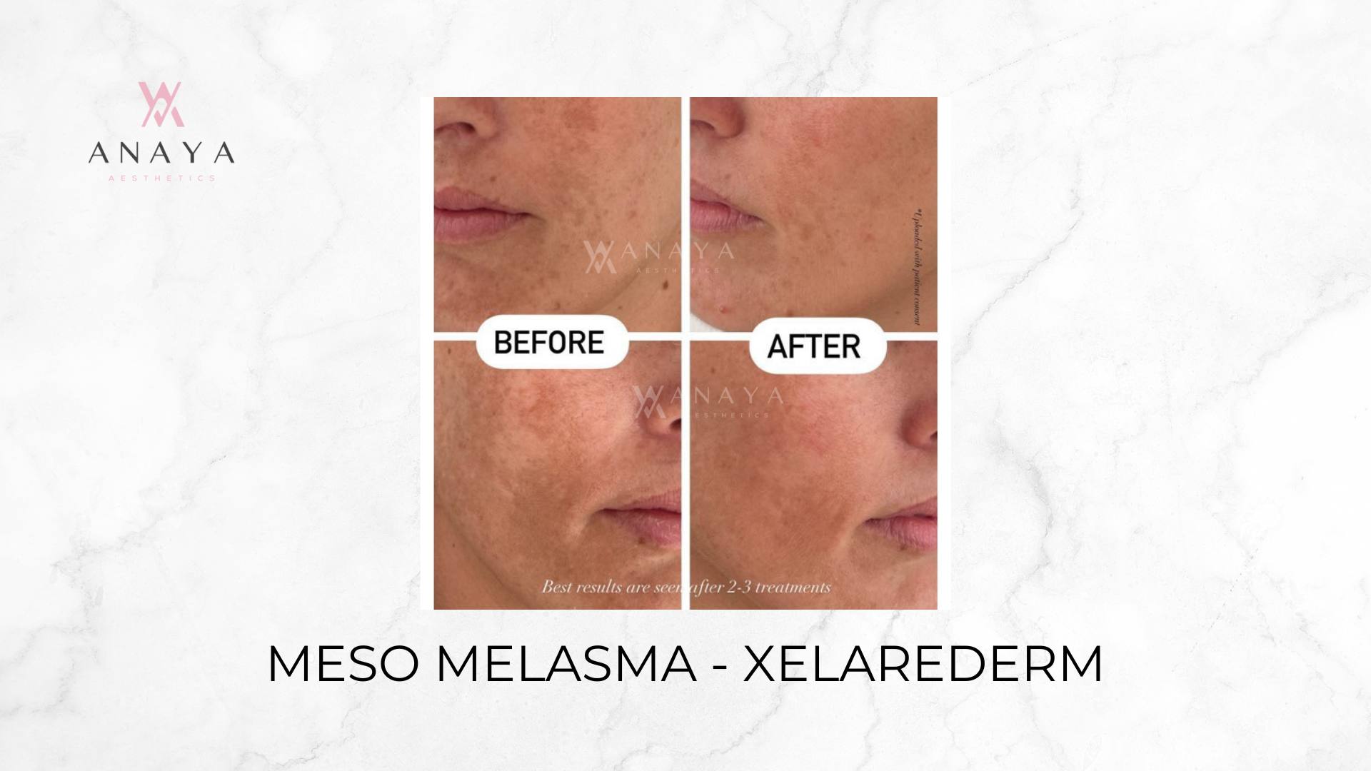 Meso Melasma - Xelarederm