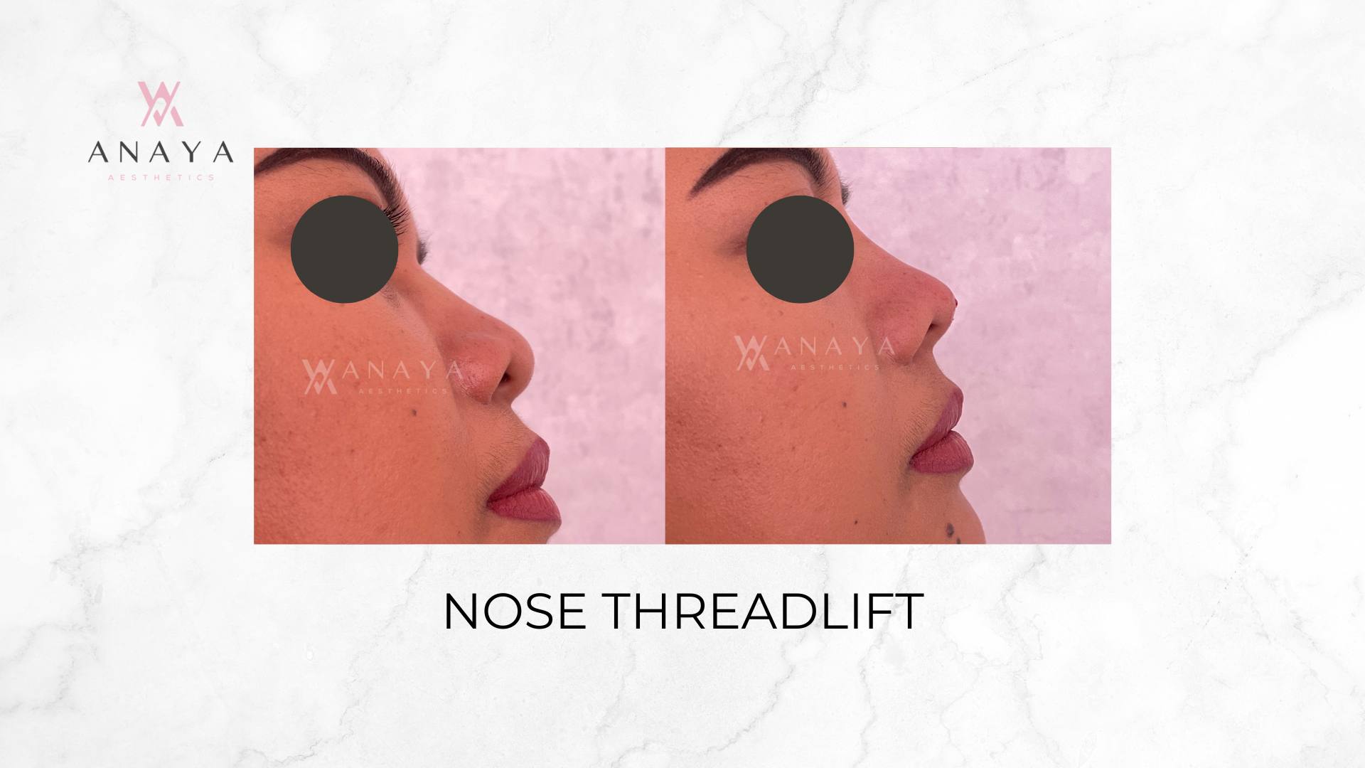 Nose Threadlift