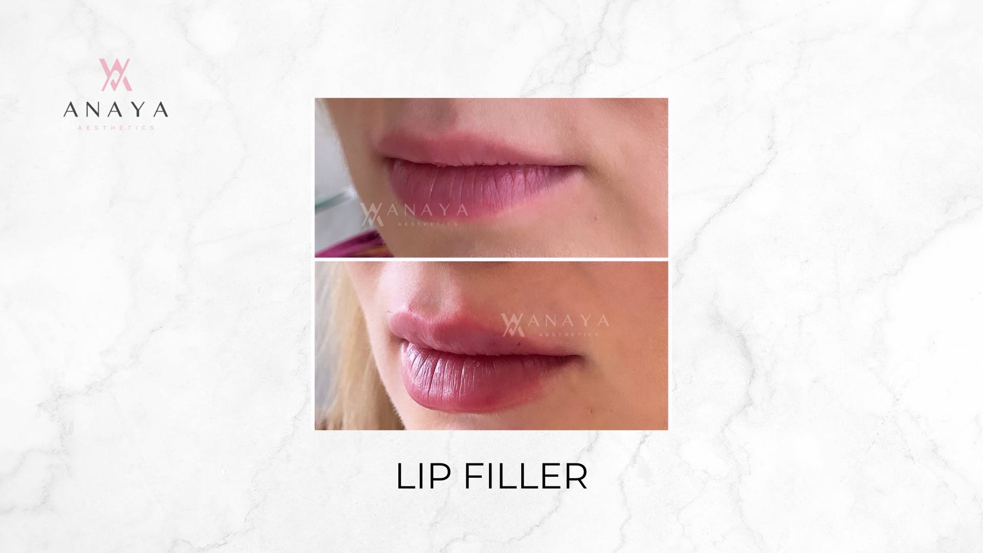 Lip Filler