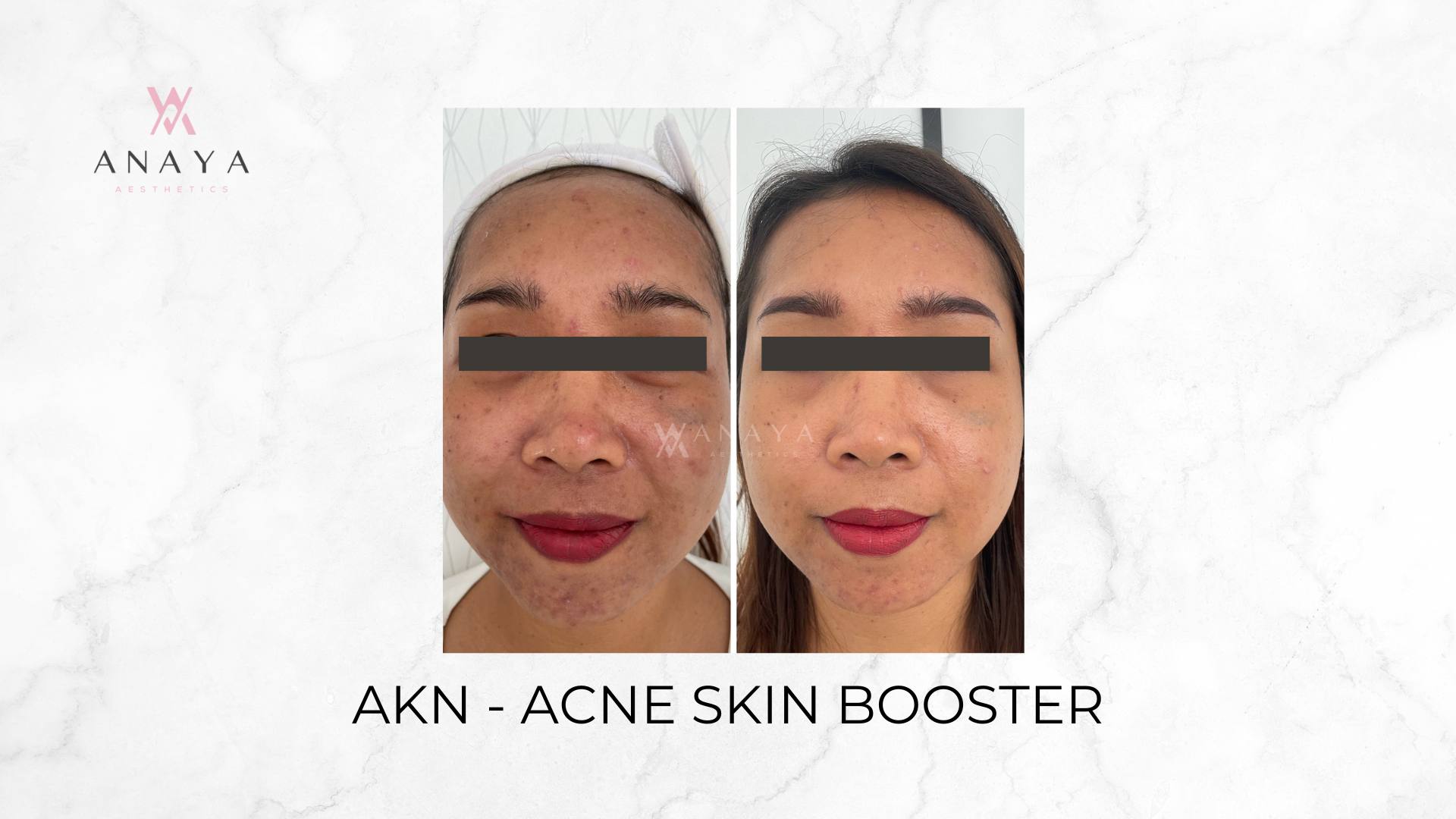 AKN - Acne Skin Booster