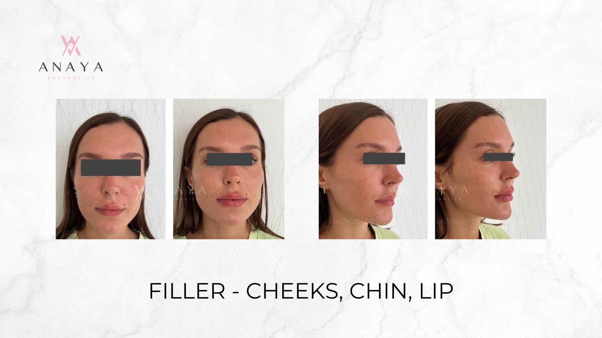 Filler - Cheeks, Chin, Lip