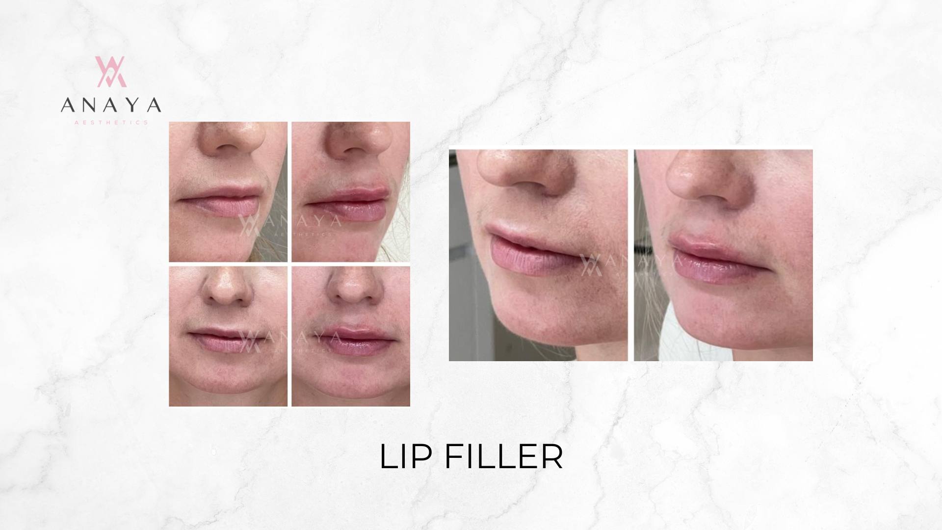 Lip Filler