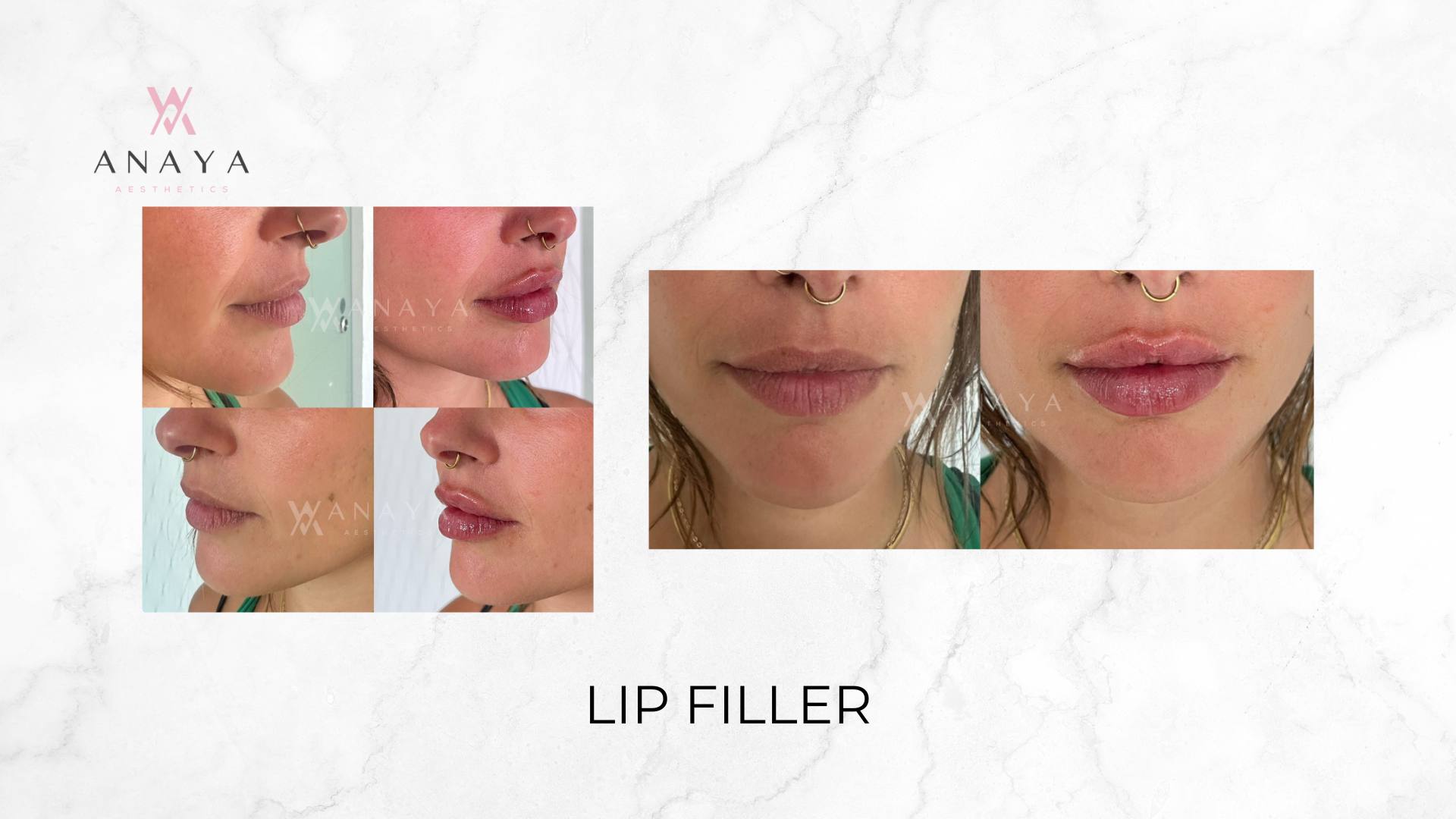 Lip Filler