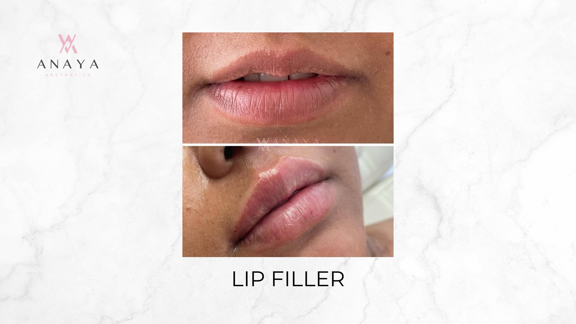 Lip Filler