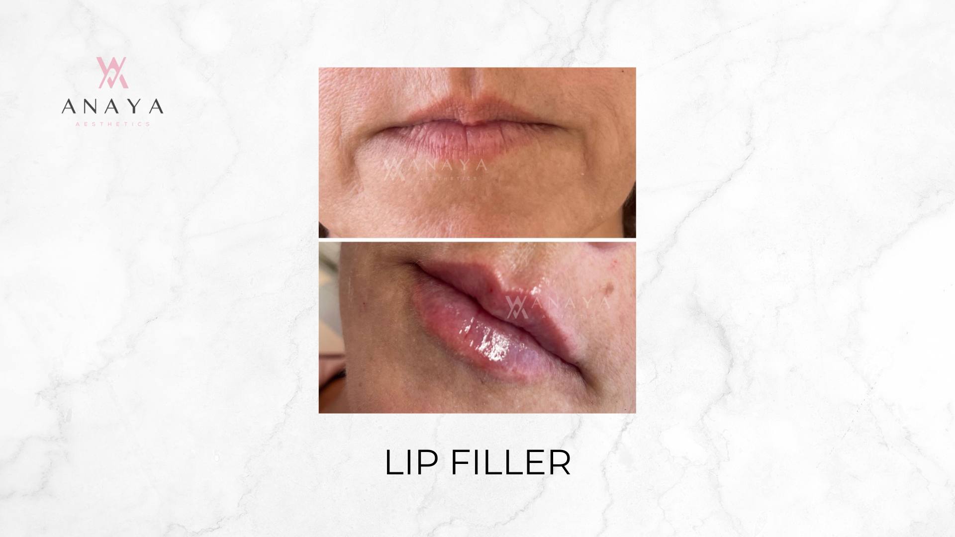 Lip Filler