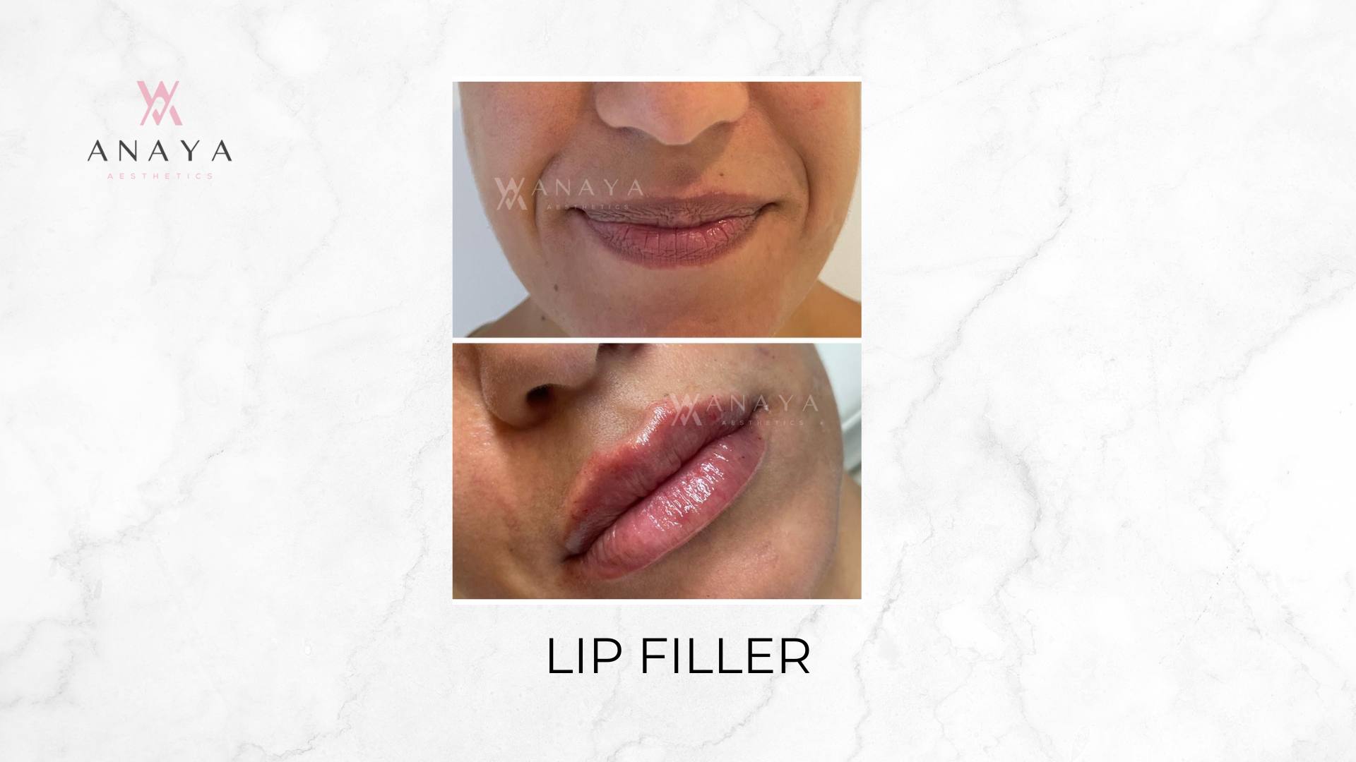 Lip Filler