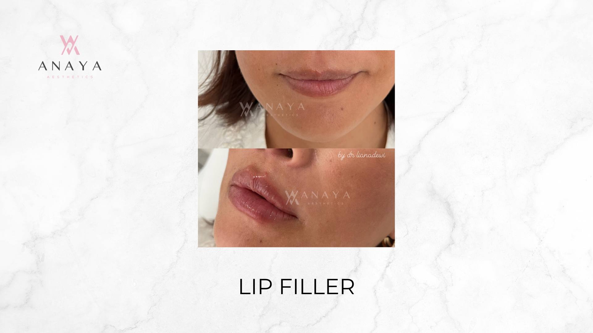 Lip Filler