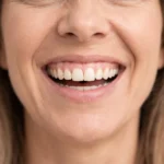 A close-up of a woman smiling broadly and showing her upper gumline, illustrating the typical 'before' condition of a patient seeking a gummy smile treatment.