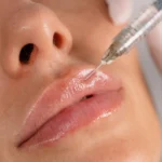 A close-up view of a fine syringe needle precisely injecting a patient's upper lip, demonstrating the technique used to relax the muscle during a lip flip Bali.