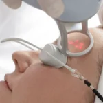 A close-up of a patient wearing protective eye shields undergoing a skin rejuvenation treatment on her forehead with a laser handpiece emitting red target beams, highlighting skin resurfacing options like Lavieen vs pico laser.