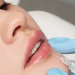 Rediscover Radiance: Juvederm Fillers at Anaya Aesthetics