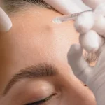 The Real Benefits of Botox: Why the Best Botox in Bali Looks Natural, Not Frozen